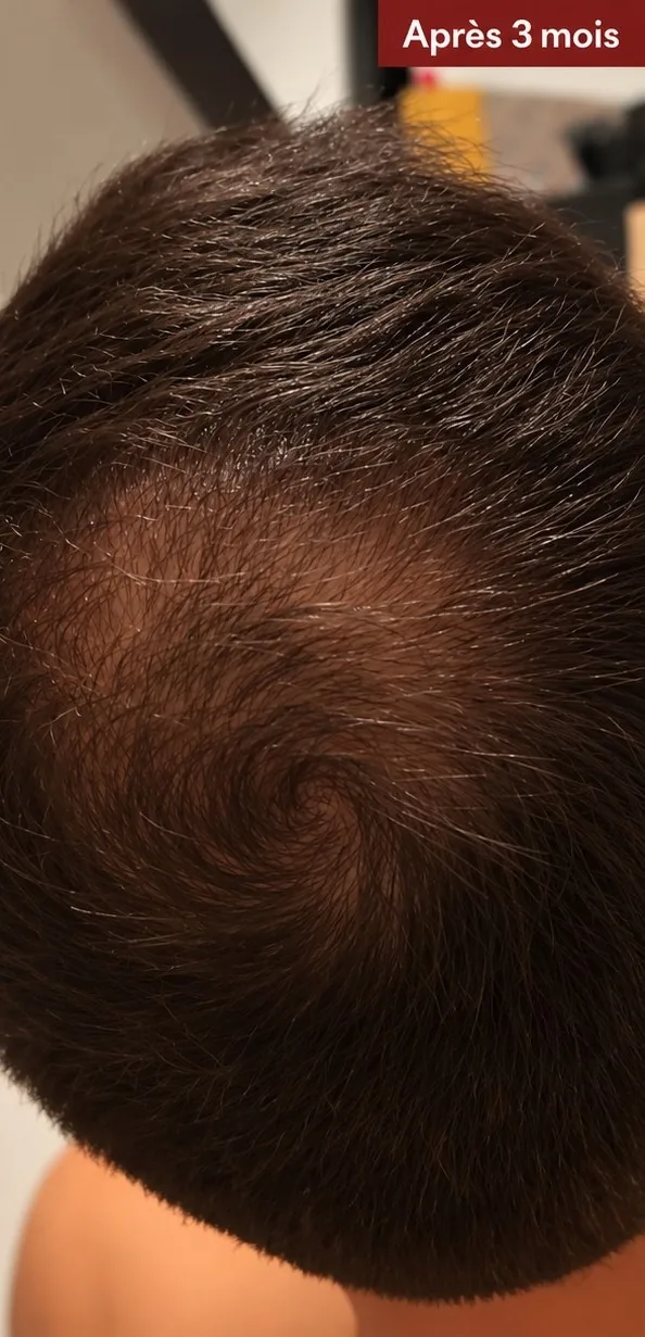 Chute de cheveux, homme, après