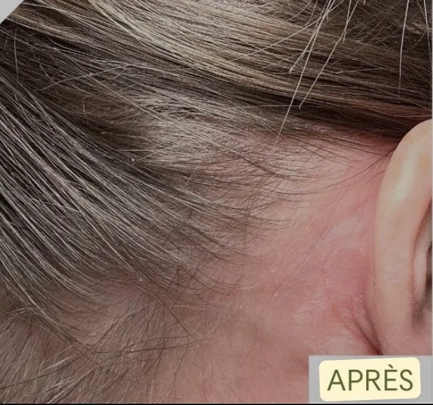Cuir chevelu irrité et squameux, après