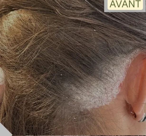 Cuir chevelu irrité et squameux, avant