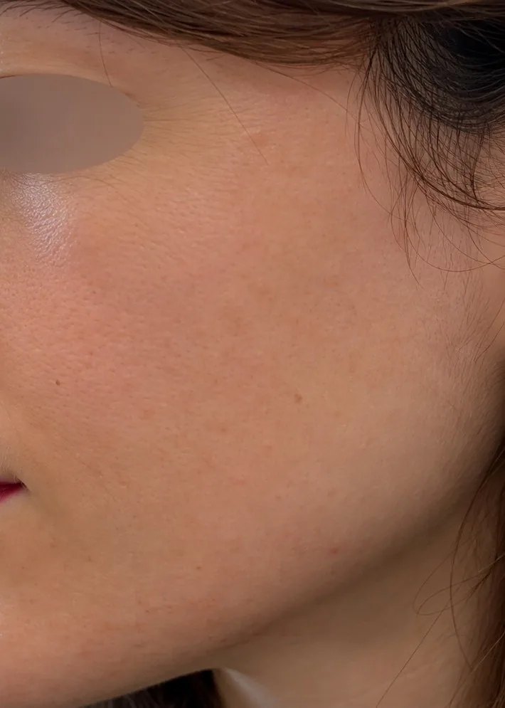 Peau à tendance acnéique, après